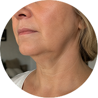 <p>Loose skin beneath<br/> the chin</p>