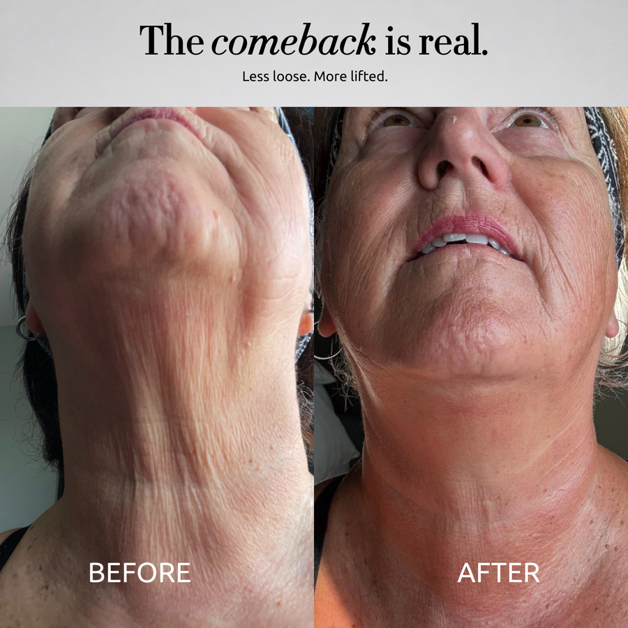 The Collagen Comeback
